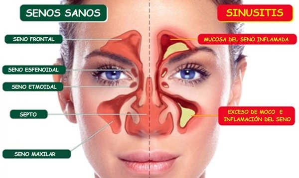 SINUSITIS